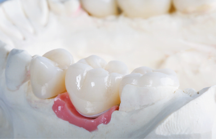 Advantages, and Disadvantages of denta crowns